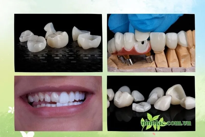 Top 8 địa chỉ bọc răng sứ Thái Nguyên